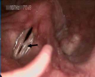 9, A apresentação dos nódulos das cordas vocais é a de uma lesão de massa, bilateral, simétrica em posição, mas variável em tamanho, localizada na transição do terço médio para o terço anterior das