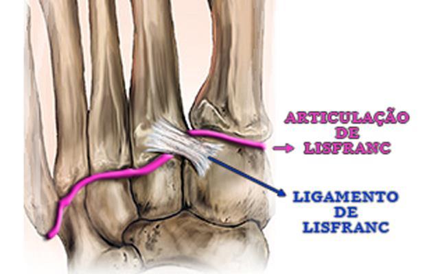 Amputação de Lisfranc Desarticulação dos