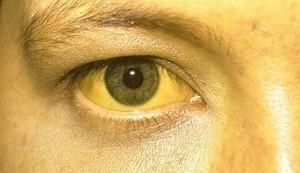 de coca-cola) Icterícia (olhos e pele amarelados) Fezes