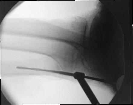 25 Figura 4B: Imagem peroperatória do joelho em perfil (radioscopia) mostrando a