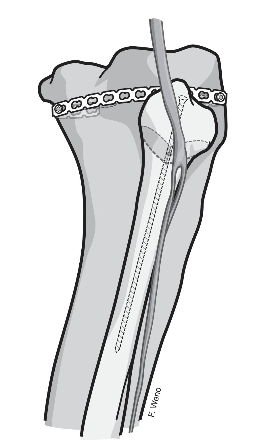 30 Fonte: Ilustração gentilmente cedida por Fernando Weno. Figura 8: Ilustração da fixação da fratura do planalto tibial com placa cinto e da osteotomia da fíbula com parafuso cortical extralongo.
