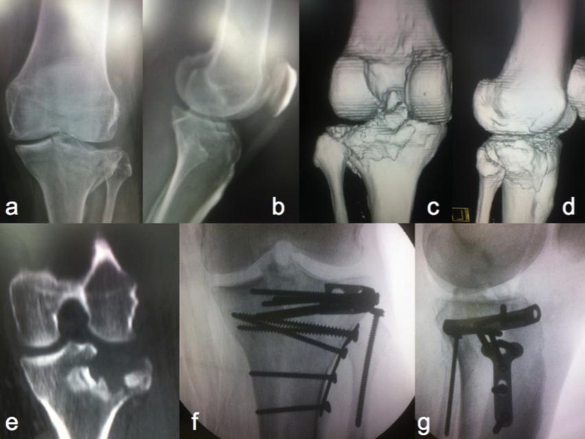 32 Figura 10: A e B: Radiografias do joelho em ântero-posterior e perfil de um paciente do gênero masculino, 42 anos, que apresentou fratura do planalto tibial Schatzker II.