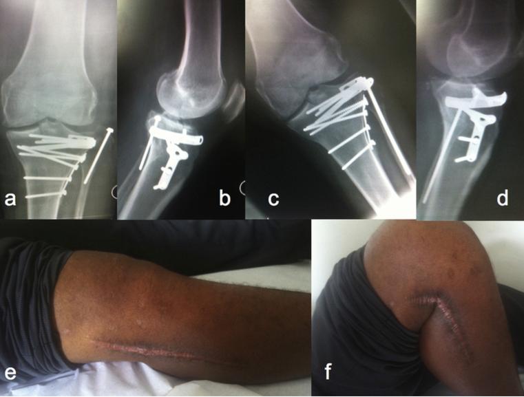 33 Figura 11: A e B: Radiografias mostrando a perda da redução e fixação da osteotomia transfibular.