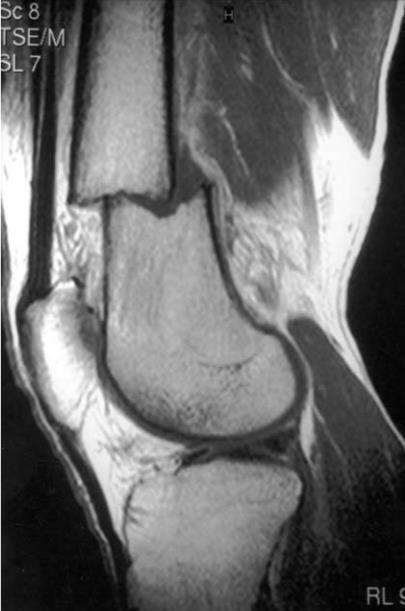 diagnosis of meniscal lesion in a case