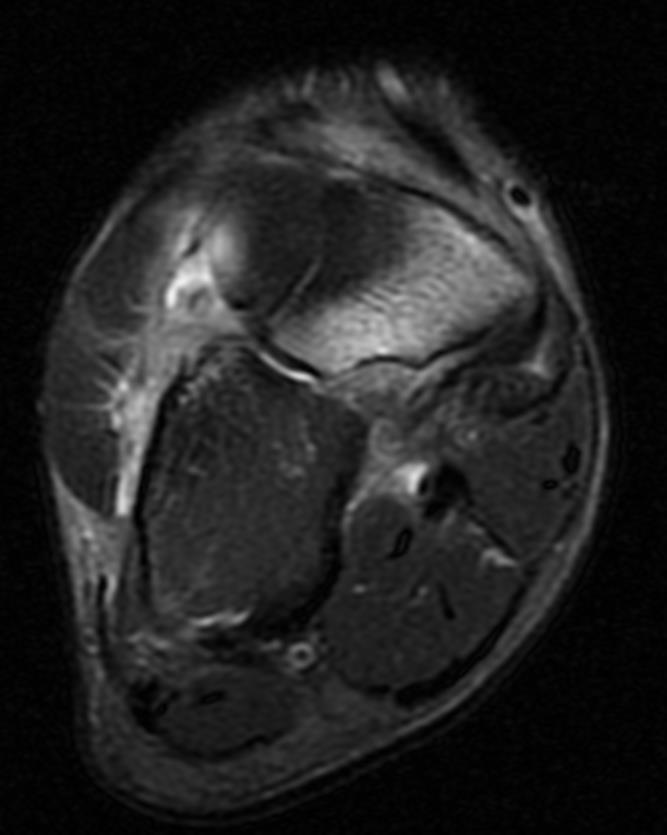 NAVICULAR Classificação Tipo I = cortical dorsal Tipo II = cortical dorsal e corpo Tipo III = fratura completa (2