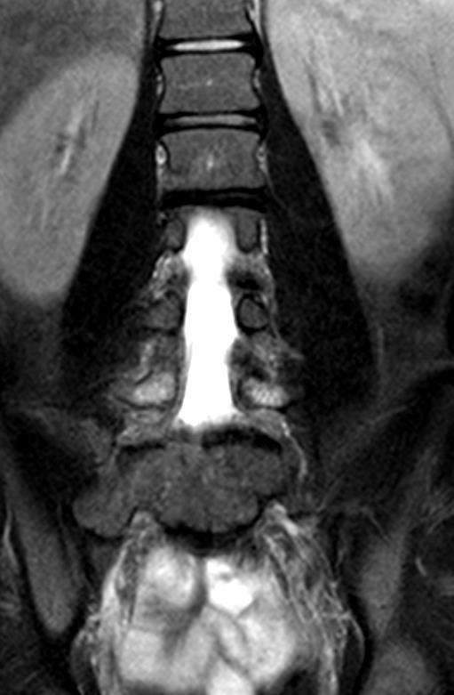 PARS INTERARTICULARIS