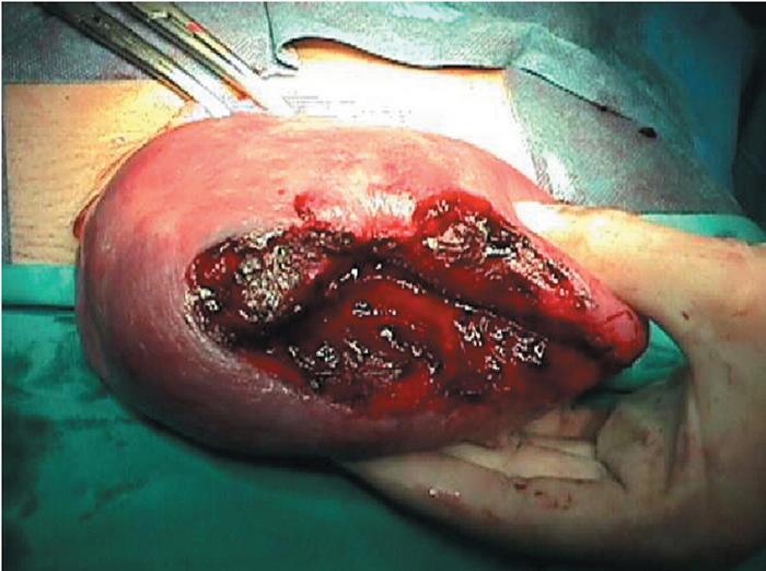 Conduta Laparotomia Extração fetal Abordagem da rotura Extração fetal a fórceps Laparotomia Abordagem da rotura PARTO