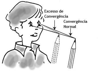 3.1.5 Excesso de Convergência O Excesso de Convergência é considerado como o problema de visão binocular com maior predominância sendo caracterizado pela presença de uma endoforia em visão de perto