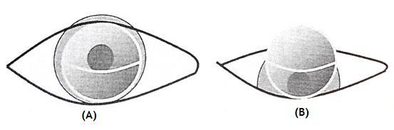 adição). Para tal é necessário que a lente se desloque em movimentos precisos nas diferentes posições do olhar.