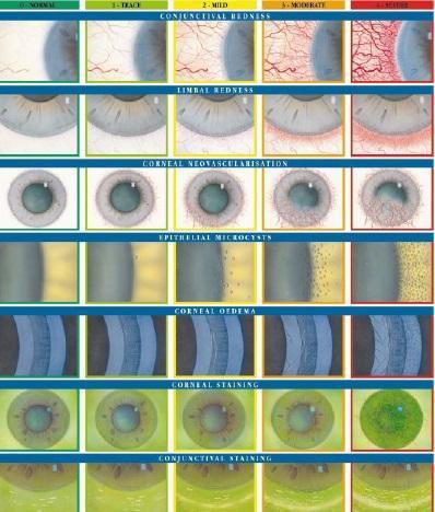oculares, sendo elas: Vermelhidão Conjuntival, Vermelhidão Limbal, Microquisto Epitelial, Edema Corneal, Lesão Corneal, Lesão Conjuntival,