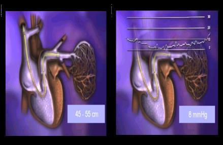 TRAÇADO CARACTERÍSTICO DE ARTÉRIA PULMONAR.