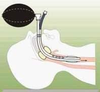Pressão do Cuff - Manter a pressão do balonete da prótese traqueal entre 18 a 22 mmhg ou 25 a 30 cmh2o (cuffometro) visando evitar