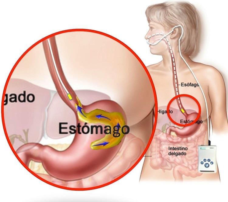 phmetria esofágica Gráfico de phmetria de 24 horas.