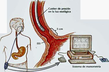 Manometria esofágica Fonte: http://www.
