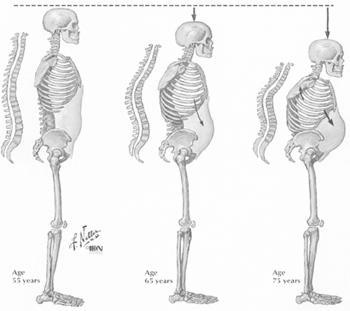 FATORES CLÍNICOS DA OSTEOPOROSE MÉDICOS