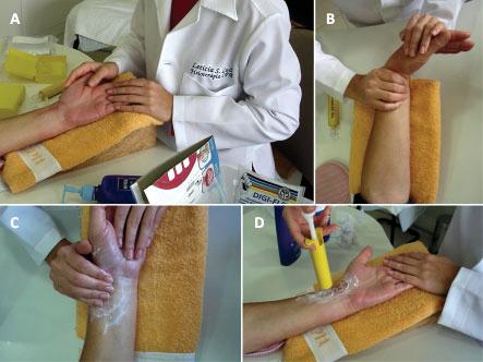 comprimento por falta de cálcio em sua estrutura. O rádio encurta em relação ao outro osso do antebraço (ulna).