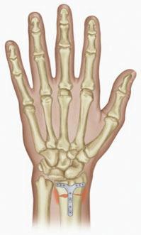 Alguns preferem a colocação de pinos intraósseos (fios de Kirschner), outros a colocação de placas na parte dorsal do osso (o que pode ocasionar a irritação dos tendões extensores) e outros a