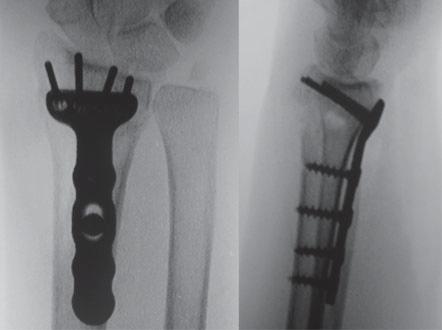 Depois do procedimento o paciente permanece um pequeno período na sala de recuperação anestésica e após vai para o quarto, ficando no hospital por um período médio de 24 horas.