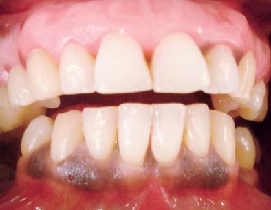 [ Periodontia ] gengival das manchas melanocíticas através de procedimento cirúrgico.