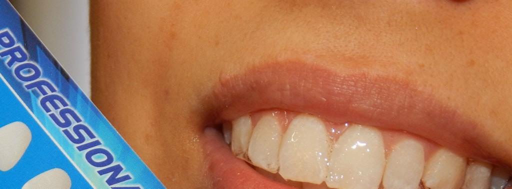 18 3.4 Técnicas de Clareamento para Dentes com Vitalidade Pulpar Clareamento dental vital é realizado em dentes que não sofreram tratamento