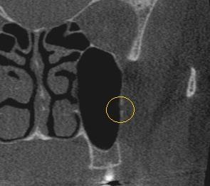 30 3 Capítulo 1: Artigo a face mesial dos dentes 18, 17, 16, 15 e 14 do lado direito e a face mesial dos dentes 28, 27, 26, 25 e 24 do lado esquerdo.