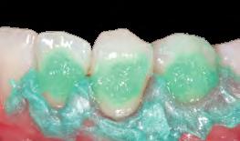 casos como este é o tratamento de toda a arcada (dentes com relevância estética no sorriso) de forma simultânea.