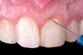 Dentes sem alteração de cor onde não pretende-se aumentar o volume vestibular. 2.