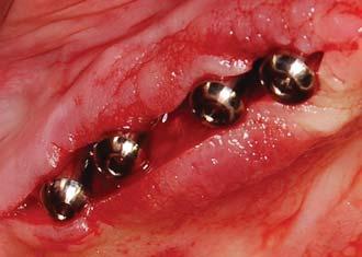 tapaimplantes Sutura