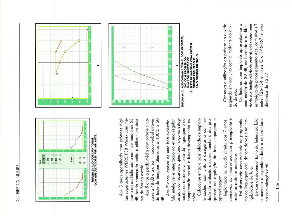 RU RBERO NUNES d8 Hz S ZS FGURA S: AUDOGRAMA TONAL COM AUSCULTADORES PRÉ-MPLANTE.