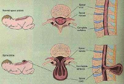 Espinha bífida: falha na fusão dos arcos das vértebras