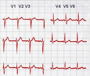 20 adquirem as derivações V 3 até V 6, são dispostos um após o outro em direção à esquerda. A Figura 8 mostra três ciclos cardíacos sucessivos adquiridos por cada uma destas derivações.