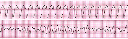 21 1.3.2 TVS - Taquicardia ventricular sustentada Difere da TVNS por possuir duração superior a 30s e necessitar de intervenção, podendo ser monomórfica (TVSM) ou polimórfica (TVSP). 1.3.3 FLUV - Flutter ventricular O FLUV apresenta-se em ECG como uma seqüência de Complexos QRS monomórficos, cujos ciclos possuem duração inferior a 200ms (Figura 9).
