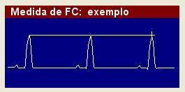 Para medir a FC a partir do traçado, clique com o botão esquerdo do mouse sobre a onda R e mova o cursor até o pico da segunda onda R consecutiva, conforme figura abaixo. mm.