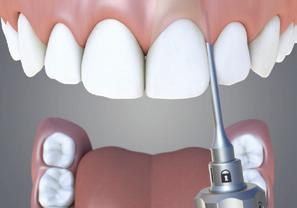 EQUIPAMENTOS DE IMPLANTOLOGIA E DE CIRURGIA 5 EXO SAFE Para a realização da extração dentária e g Inclusão progressiva e