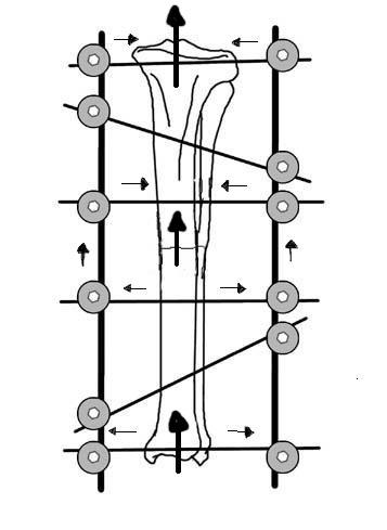 A 1 A 2 A 3 Figura 1. A1: Sistema de fixação com partilha ideal de cargas. Uma fractura transversa foi anatomicamente reduzida e compressada.