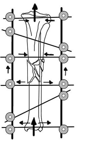 Nenhumas das cargas que o membro sofre são transmitidas através do foco de fractura; em vez disso toda a carga é transmitida de um segmento ósseo para o outro segmento ósseo através do meio de