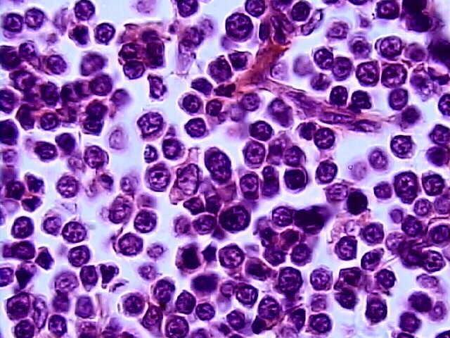 Figura 4: Fotomicrografia de linfonodo canino. Observar o padrão difuso de células neoplásicas redondas com nucléolo único e central.
