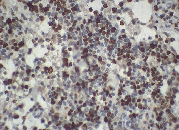 Figura 6: Fotomicrografia de linfoma canino multicêntrico de células T.