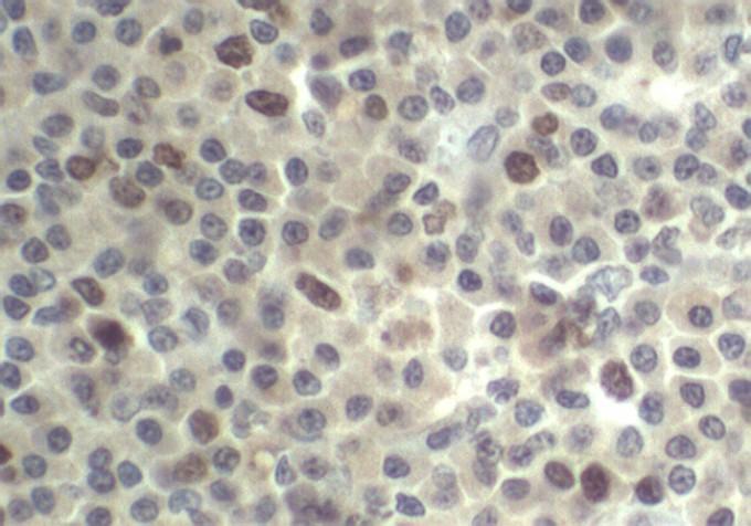 Setas pretas apresentam células fracamente marcadas e setas brancas células fortemente marcadas pelo anitcorpo anti-pcna 40X.