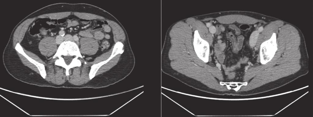 Figura 1. PET/CT com 68 Ga-PSMA mostrando hiperconcentração do radiofármaco em linfonodos pélvicos, obturatório e ilíaco externo esquerdos, confirmados como metastáticos.
