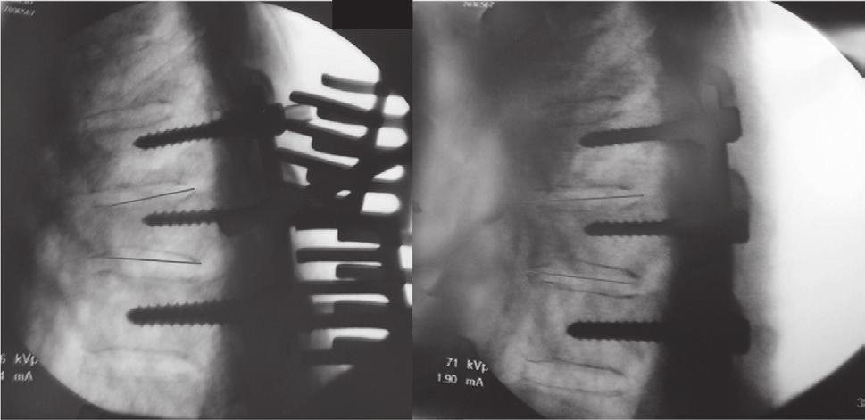 posterior curta segmentar com moldagem in situ.