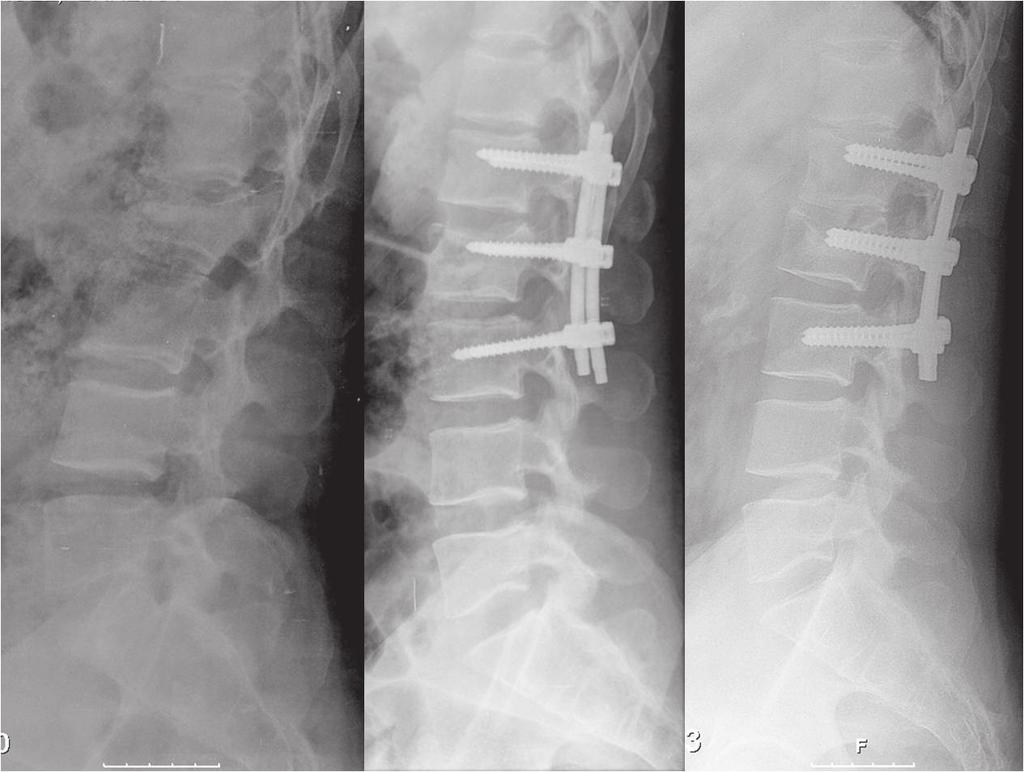 anterior do corpo vertebral >50%. TÉCNICA CIRÚRGICA O paciente é posicionado em decúbito ventral e a mesa é quebrada para ajudar na redução (Figura 1).