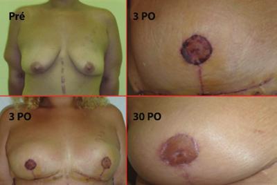 Okada A et al. Figura 7 Paciente de 27 anos, 95 kg e 1,72 m, que apresentou epiteliose do complexo areolopapilar direito, com restauração completa após 21 dias.