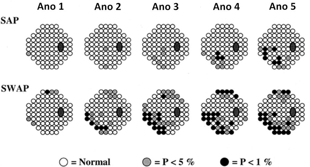 Demirel et al. publicaram em 2001, um estudo para determinar a incidência e a prevalência de alterações glaucomatosas nos testes SWAP e SAP, em pacientes com hipertensão ocular.