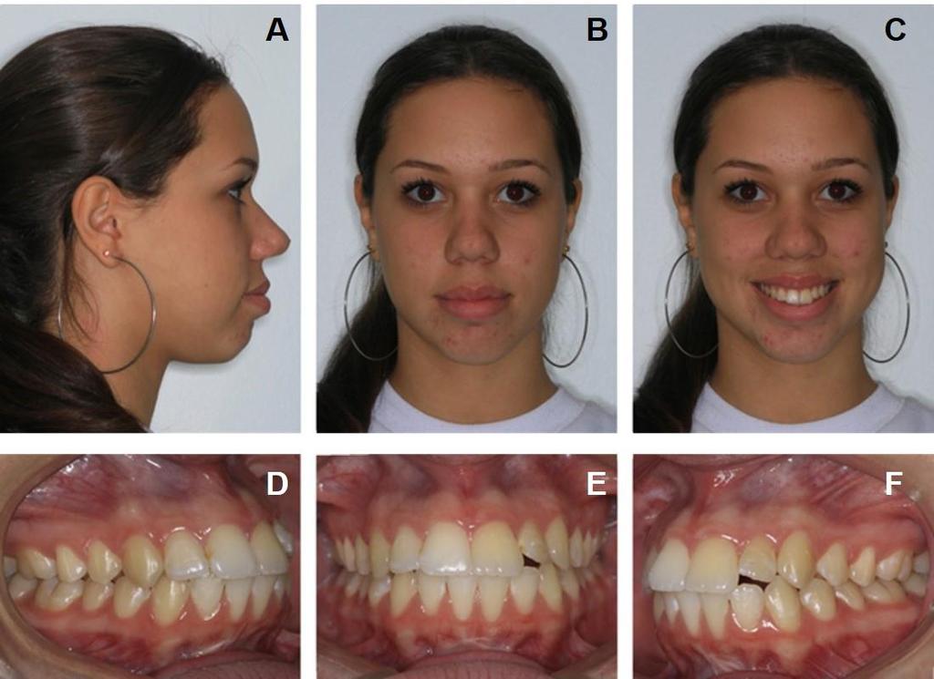 24 No exame intrabucal (Figura 1 D a F; Figura 2), observou-se uma má oclusão de classe I, com apinhamento leve no arco superior.