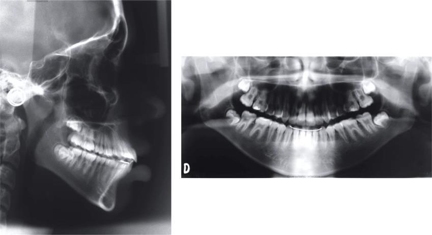 protrusão dentoalveolar.