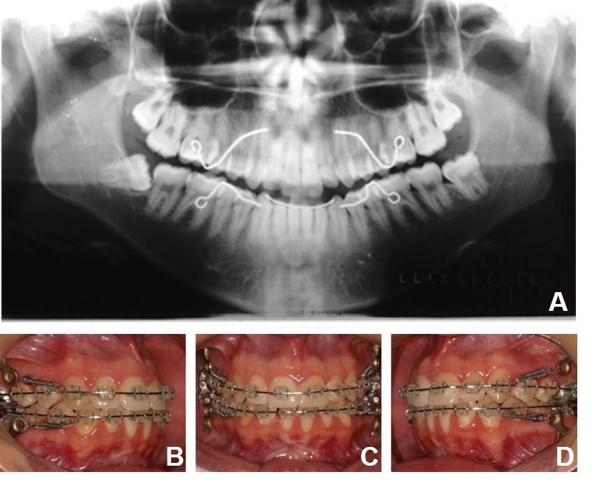 29 Durante a retração dos dentes superiores e inferiores, houve tendência dos molares inclinarem para distal.