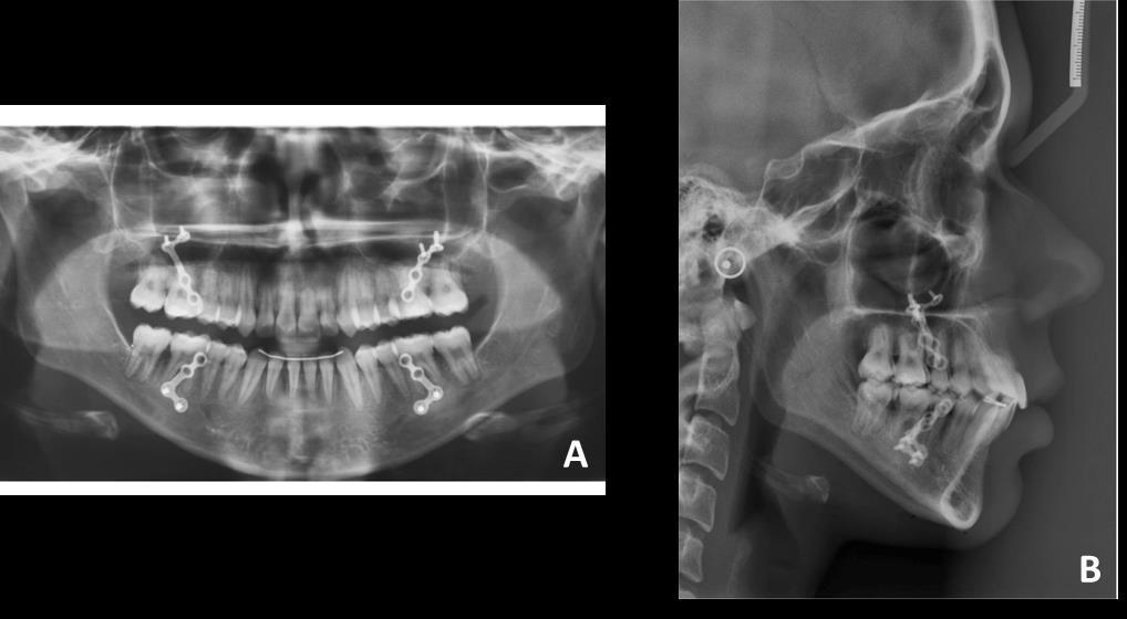 32 Figura 7 Radiografias panorâmica (A) e