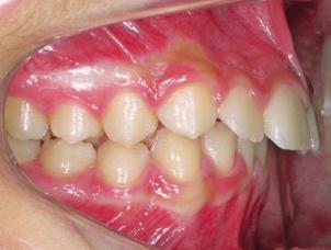 Classe II dentária tratados com distalizadores