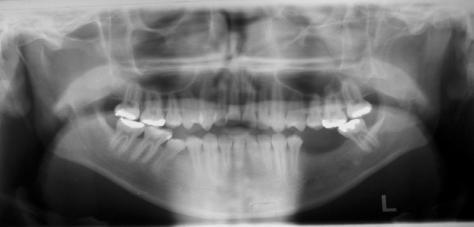 Figura 3. Panorâmica inicial. Na telerradiografia inicial foi observado o aumento da AFAI, característico no padrão dolicofacial (Figura 4).